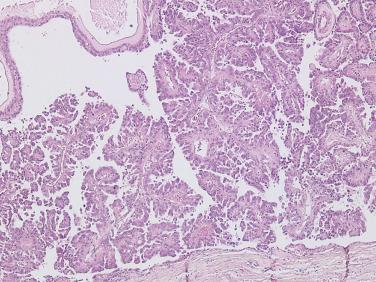FIG. 12A.18, Hereditary leiomyomatosis and renal cell carcinoma–associated renal cell carcinoma. There is a papillary and cystic architecture.