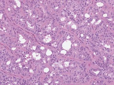 FIG. 12A.19, Hereditary leiomyomatosis and renal cell carcinoma–associated renal cell carcinoma. Most of the nuclei contain large eosinophilic nucleoli.