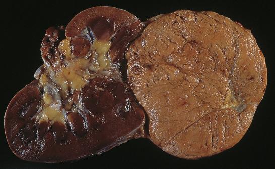 FIG. 12A.20, Chromophobe renal cell carcinoma. This light brown or tan globular tumor is well circumscribed.