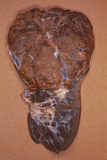 FIG. 12A.2, Renal oncocytoma. This large bulging tumor is homogeneously mahogany brown.