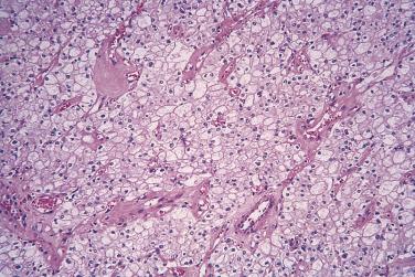 FIG. 12A.21, Chromophobe renal cell carcinoma. In sections stained with hematoxylin and eosin the cytoplasm of typical chromophobe renal cell carcinoma is pale pink and flocculent.