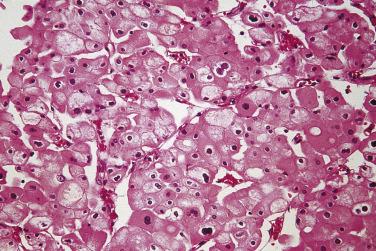 FIG. 12A.24, Chromophobe renal cell carcinoma. The eosinophilic variant of chromophobe carcinoma is composed of cells with deeply eosinophilic finely granular cytoplasm.