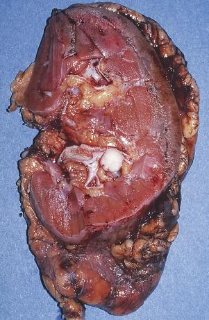 FIG. 12A.26, Collecting duct carcinoma. This small whitish tumor has arisen in the renal medulla.