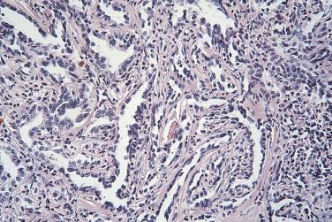 FIG. 12A.27, Collecting duct carcinoma. Tubules with jagged branching lumens embedded in an abundant stroma and lined by cells with small amounts of cytoplasm are typical of collecting duct carcinoma.