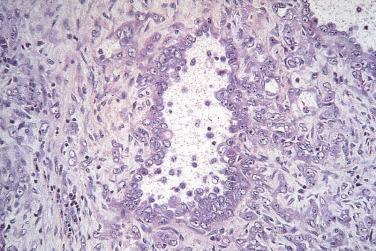 FIG. 12A.28, Collecting duct carcinoma. Slightly basophilic cytoplasm reminiscent of the renal medulla and hobnail cells lining ducts and small cysts are features of collecting duct carcinomas.