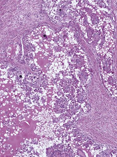 FIG. 12A.29, Xp11 translocation carcinoma. Large cells with eosinophilic cytoplasm and psammoma bodies with papillary and compact architecture.