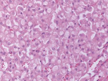 FIG. 12A.30, Succinate dehydrogenase-deficient renal cell carcinoma. Cytoplasmic inclusions and vesicles are characteristic of this tumor.