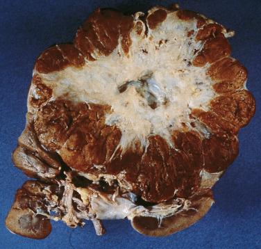 FIG. 12A.3, Renal oncocytoma. These tumors, especially the larger ones, often have central areas of whitish stroma which may undergo cavitary degeneration.