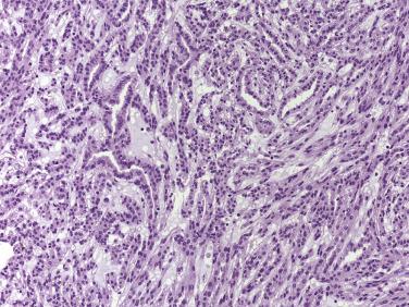 FIG. 12A.31, Mucinous tubular and spindle cell carcinoma. Cuboidal and spindle cells in a mucinous extracellular matrix.