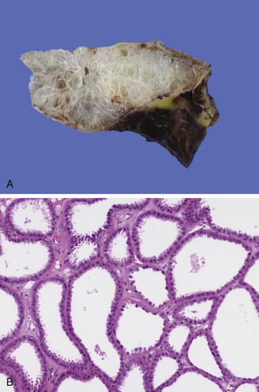 FIG. 12A.32, Tubulocystic renal cell carcinoma. (A) The tumor is composed of small cysts filled with clear fluid. (B) The cysts are lined by cuboidal cells with uniform nuclei with prominent nucleoli.