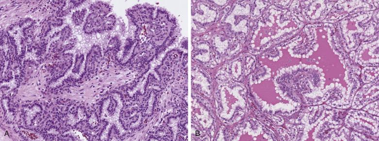 FIG. 12A.33, Clear cell papillary renal cell carcinoma. (A) Papillae with broad cores and cellular stroma are common. (B) Cysts and acini are common. The abundant clear cytoplasm at the lumenal ends of the cells and the cellularity of the stroma are subtle clues to the diagnosis. The tendency to form short blunt papillae is evident even in small cysts.