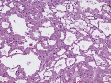 FIG. 12A.34, Acquired cystic disease–associated carcinoma. Cysts, cribriform architecture, and oxalate crystals are present in this field.