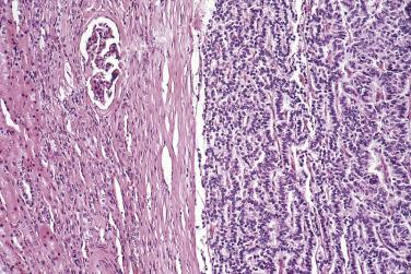 FIG. 12A.35, Renal carcinoid. The cells are arranged in ribbons and the tumor is well circumscribed.