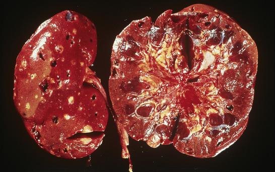 FIG. 12A.36, Angiomyolipoma. The kidneys of a patient with tuberous sclerosis contain multiple small yellowish tumors, typical of angiomyolipomas associated with this disorder.