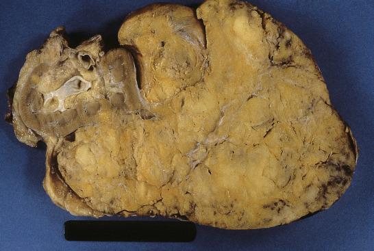 FIG. 12A.37, Angiomyolipoma. A massive solitary tumor composed of lobulated yellowish tissue is typical of sporadic cases of angiomyolipoma.