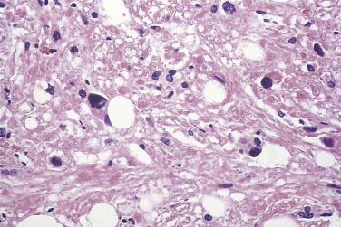 FIG. 12A.40, Angiomyolipoma. Occasionally the smooth muscle cells are epithelioid and may exhibit nuclear atypia.