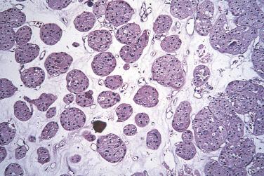 FIG. 12A.4, Renal oncocytoma. Cells with abundant eosinophilic cytoplasm are clustered in islands in an edematous stroma.