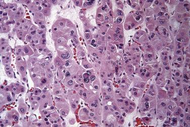 FIG. 12A.5, Renal oncocytoma. Foci in which there are enlarged, degenerate-appearing nuclei, sometimes with cytoplasmic invaginations, are seen in some oncocytomas.