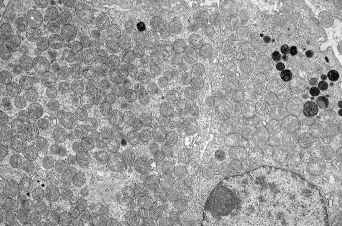 FIG. 12A.6, Renal oncocytoma. Ultrastructurally, the cytoplasm of oncocytoma cells is filled with mitochondria and other organelles are scanty.