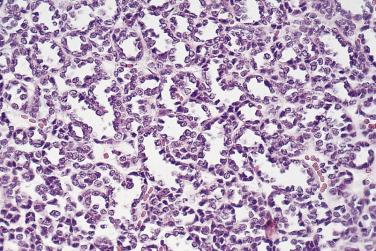 FIG. 12A.7, Metanephric adenoma. Small tubules are lined by bland cells with scant cytoplasm.