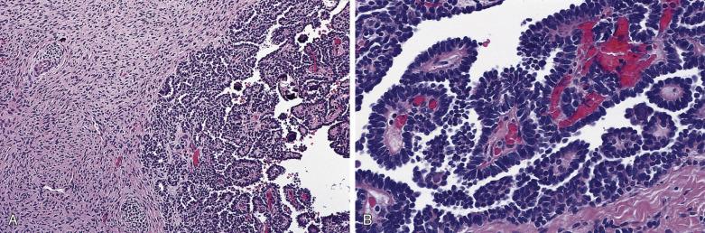 FIG. 12A.8, Metanephric adenofibroma. Abrupt transition is evident between the fibroma component, consisting of spindle cells with moderate cellularity, and an epithelial nodule with psammoma bodies (A). The epithelial component consists of papillary fronds covered by small, uniform cuboidal or columnar cells (B).