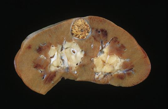 FIG. 12A.9, Clear cell renal cell carcinoma. This 1-cm tumor is yellow, spheroidal, and well circumscribed.