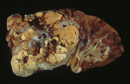 FIG. 12A.10, Clear cell renal cell carcinoma. This large, bulging tumor shows the typical variegation of color, from yellow to tan and brown with dark areas of hemorrhage and whitish areas of stroma.