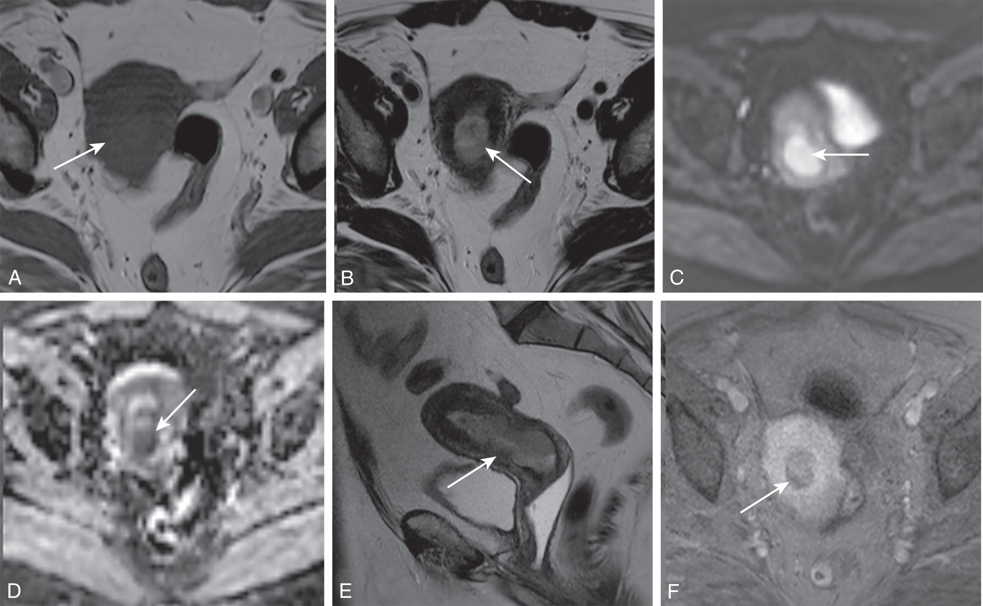 Figure 25.12, A 55-year-old woman with postmenopausal bleeding caused by carcinosarcoma. Axial T1-weighted ( A ) and axial T2-weighted (T2W) ( B ) magnetic resonance imaging (MRI) demonstrate a T1-isointense, T2-hyperintense mass ( white arrows ). Axial diffusion-weighted (DW) ( C ) and axial apparent diffusion coefficient (ADC) ( D ) images demonstrate the restricted diffusion of this mass ( white arrows ), associated with increased signal on DW images and reduced signal on the corresponding ADC images. E , Sagittal T2W images demonstrate the extent of tumor ( white arrow ) occupying the endometrial cavity and extending inferiorly to distend the cervical canal. F , Axial postcontrast fat-suppressed MRI demonstrates the relative hypoenhancement of this mass ( white arrow ), a nonspecific finding that can also be seen with conventional endometrial carcinomas.