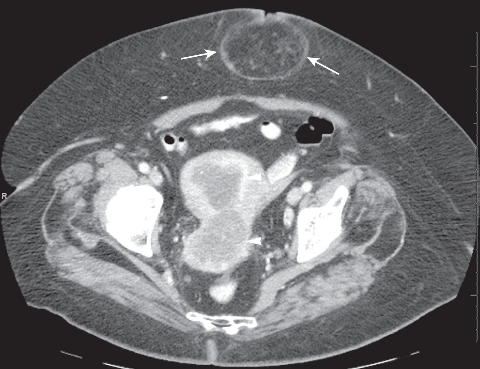 Figure 25.2, An 80-year-old woman with postmenopausal bleeding. Contrast-enhanced axial computed tomography scan shows an intrauterine mass with invasion of the lower uterine segment and cervix ( white arrowheads ), histologically confirmed as endometrial carcinoma.