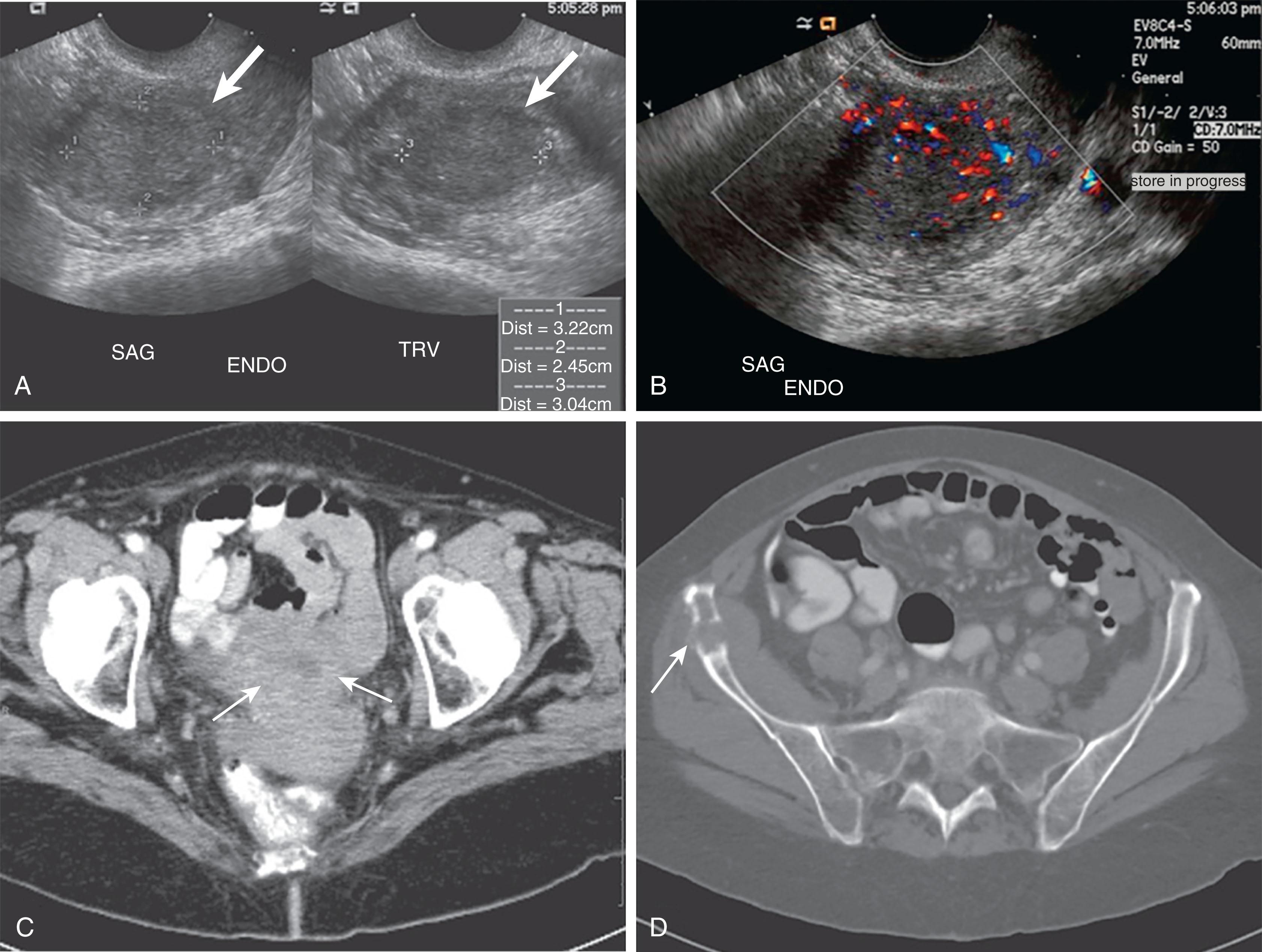 Figure 25.3, A 69-year-old woman with postmenopausal bleeding and right hip pain. A , Transvaginal ultrasound (sagittal and transverse images) demonstrate a heterogeneous solid, mildly hypoechoic, intrauterine mass ( white arrows ). B , Transvaginal ultrasound sagittal view with color Doppler demonstrates intralesional blood flow. C , Contrast-enhanced axial computed tomography (CT) scan demonstrates a poorly defined solid intrauterine mass ( white arrows ). D , Axial CT scan demonstrates an osteolytic metastatic lesion ( white arrow ) of the anterior right iliac bone, histologically confirmed as metastatic endometrial carcinoma. ENDO, SAG, TRV .