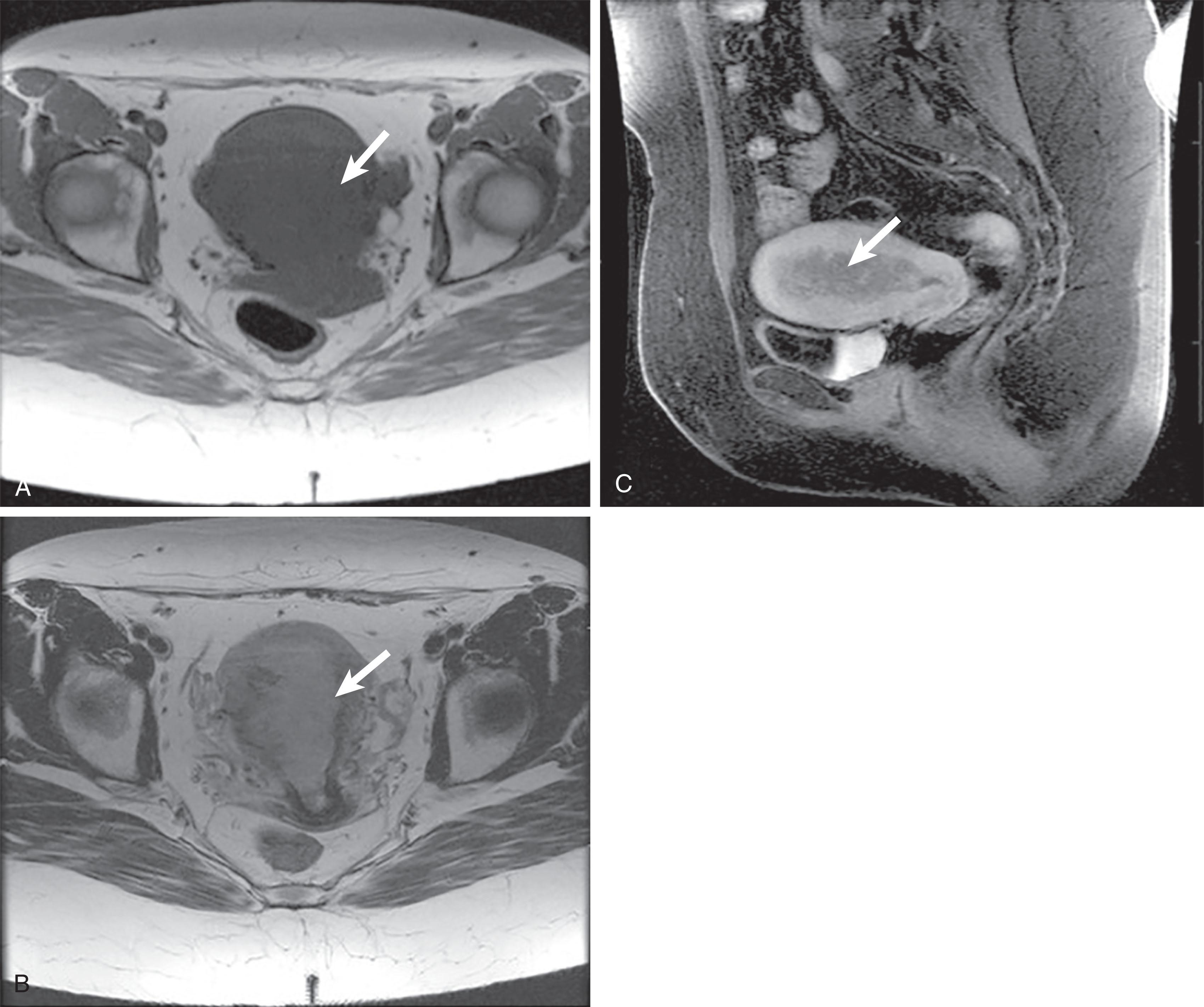 Figure 25.4, A 51-year-old woman with postmenopausal bleeding. A , Axial T1-weighted magnetic resonance imaging (MRI) study with an isointense uterus without a definable mass. B , Axial T2-weighted MRI study demonstrates a mass that is hyperintense relative to the normal uterine myometrium, junction zone, and cervical stroma ( white arrows ) C , Sagittal T1 fat-suppressed MRI following contrast administration redemonstrates the intrauterine mass ( white arrow ) that enhances less avidly than the subjacent myometrium.