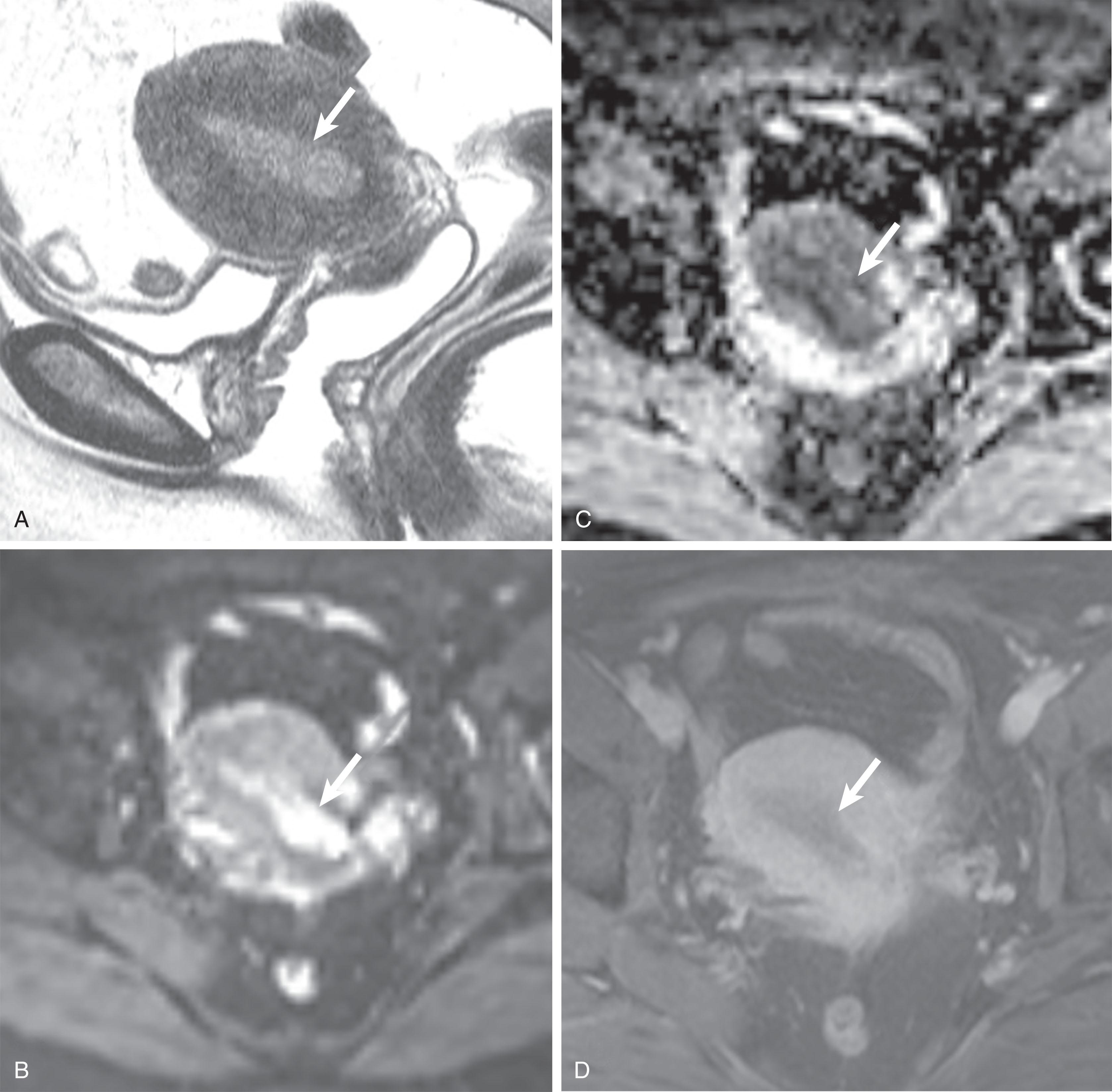 Figure 25.5, A 34-year-old woman with intermenstrual bleeding. A , Sagittal T2-weighted magnetic resonance imaging of the pelvis demonstrates a nonspecific mildly prominent endometrial stripe ( white arrow ). B , Axial diffusion-weighted (DW) images and C , axial ADC images demonstrate the restricted diffusion associated with the endometrium, with increased signal on the DW images and corresponding reduced signal on the apparent diffusion coefficient map ( white arrows in B and C ). D , Axial T1-weighted images with fat suppression demonstrate hypoenhancement of the endometrium (white arrow) compared with the myometrium. This was a clinical and histologically confirmed International Federation of Gynecology and Obstetrics stage I endometrioid adenocarcinoma, and the patient underwent fertility-sparing therapy (progestin-containing intrauterine device).