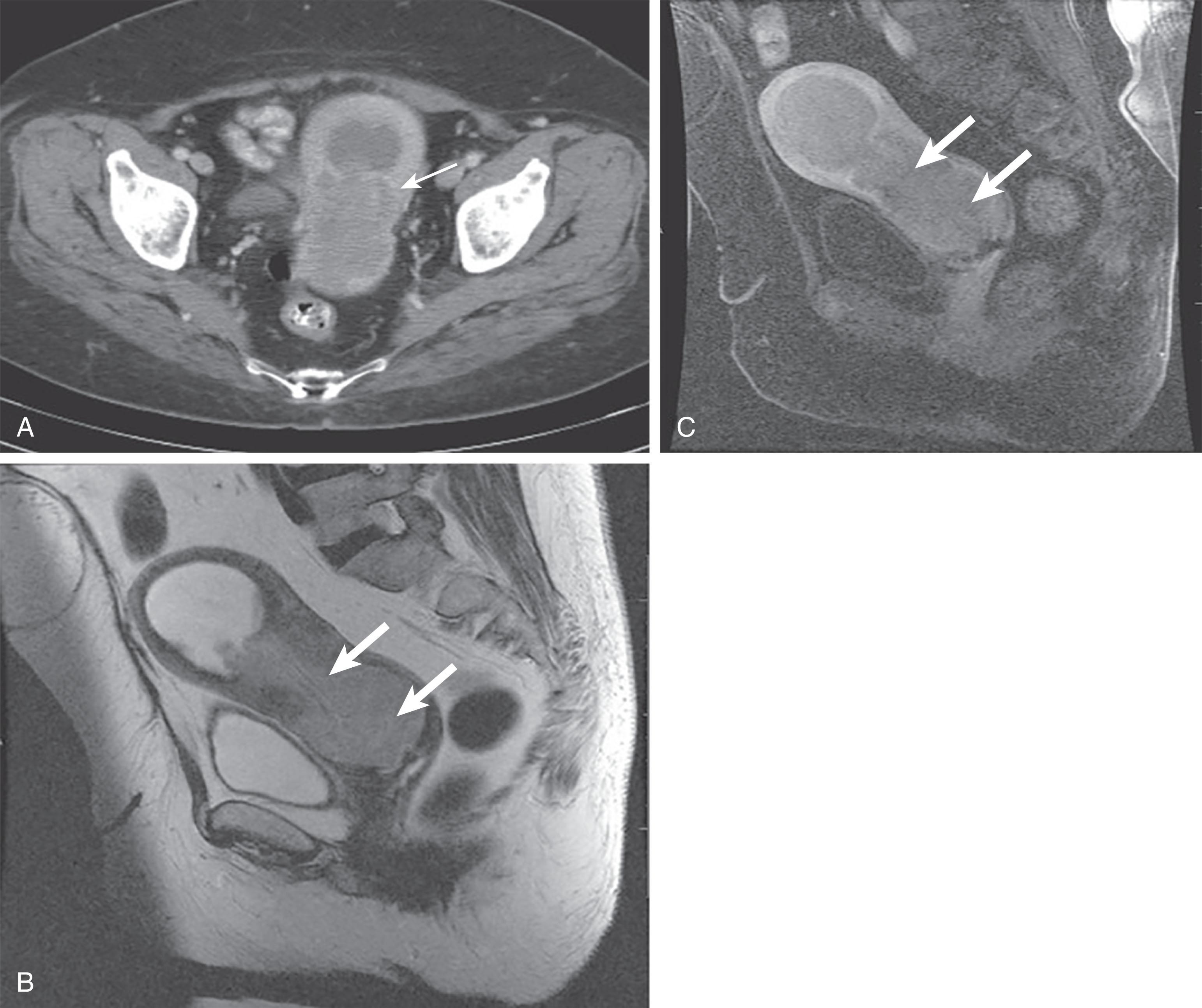 Figure 25.6, A 62-year-old woman with postmenopausal bleeding. A , Contrast-enhanced computed tomography scan demonstrates an intrauterine mass ( white arrow ) extending from the uterine body segment to involve the cervix. B , Sagittal T2-weighted magnetic resonance imaging (MRI) study demonstrates the intrauterine mass extending from the mid uterine body to the cervix ( white arrows ). C , Sagittal fat-suppressed postcontrast MRI of the pelvis demonstrates the relative hypoenhancement of the tumor ( white arrows ) as compared with the adjacent myometrium.