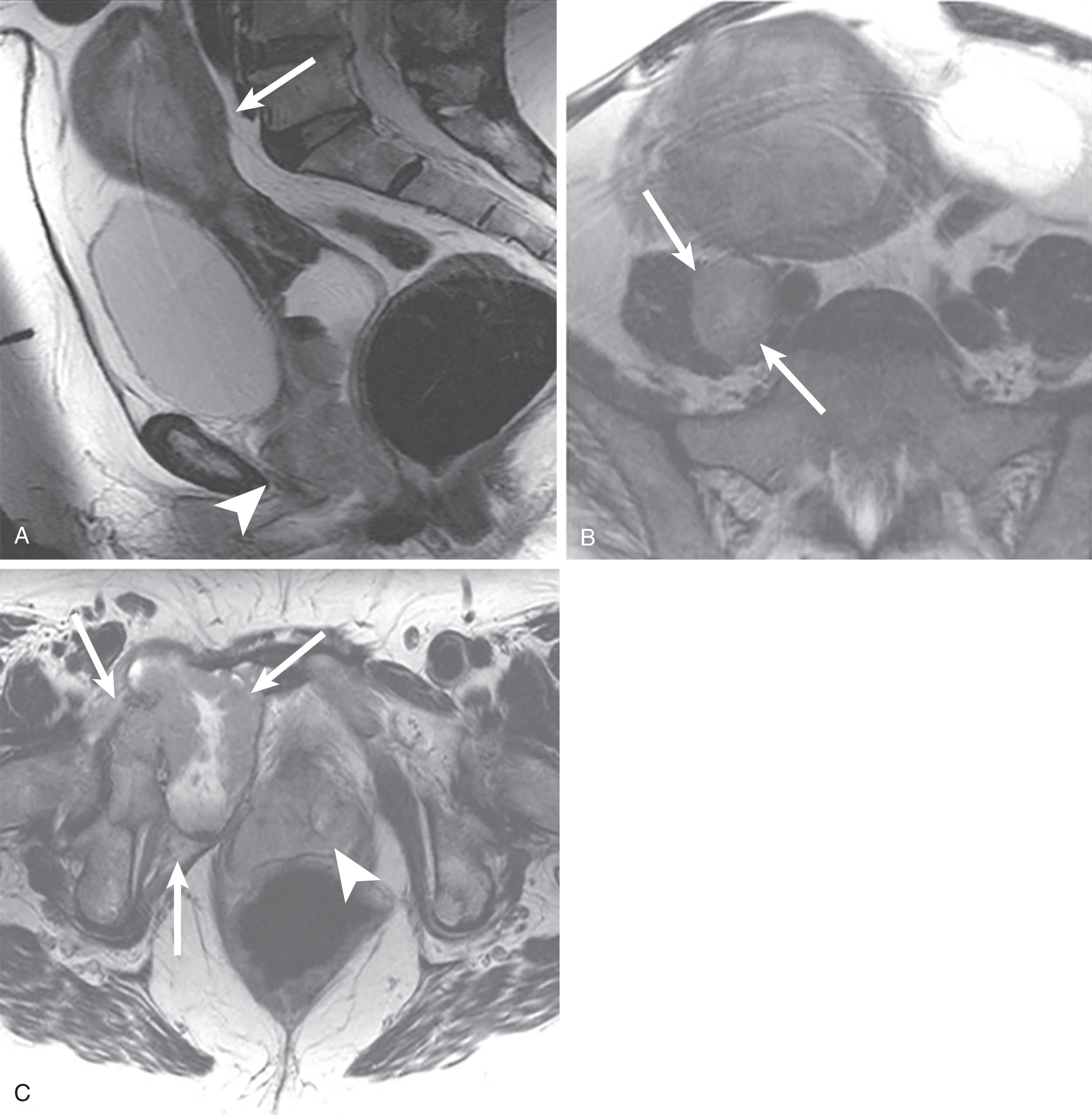 Figure 25.8, A 73-year-old woman with postmenopausal bleeding and International Federation of Gynecology and Obstetrics stage IVb endometrial carcinoma with right common iliac lymph nodes and pelvic osseous metastases. A , Sagittal T2-weighted magnetic resonance imaging (MRI) of the pelvis demonstrates a T2-hyperintense mass replacing the normal endometrial cavity ( white arrow ), with concomitant tumor involvement detected at the level of the lower vagina ( white arrowhead ) involving the posterior wall of urinary bladder. B , Axial T2-weighted (T2W) MRI demonstrates concomitant right common iliac metastatic adenopathy ( paired white arrows ). C , Axial T2W image inferiorly in the pelvis redemonstrates tumor at the level of the lower vagina ( white arrowhead ) and a right acetabular and right parasymphyseal pubis metastasis (white arrows).