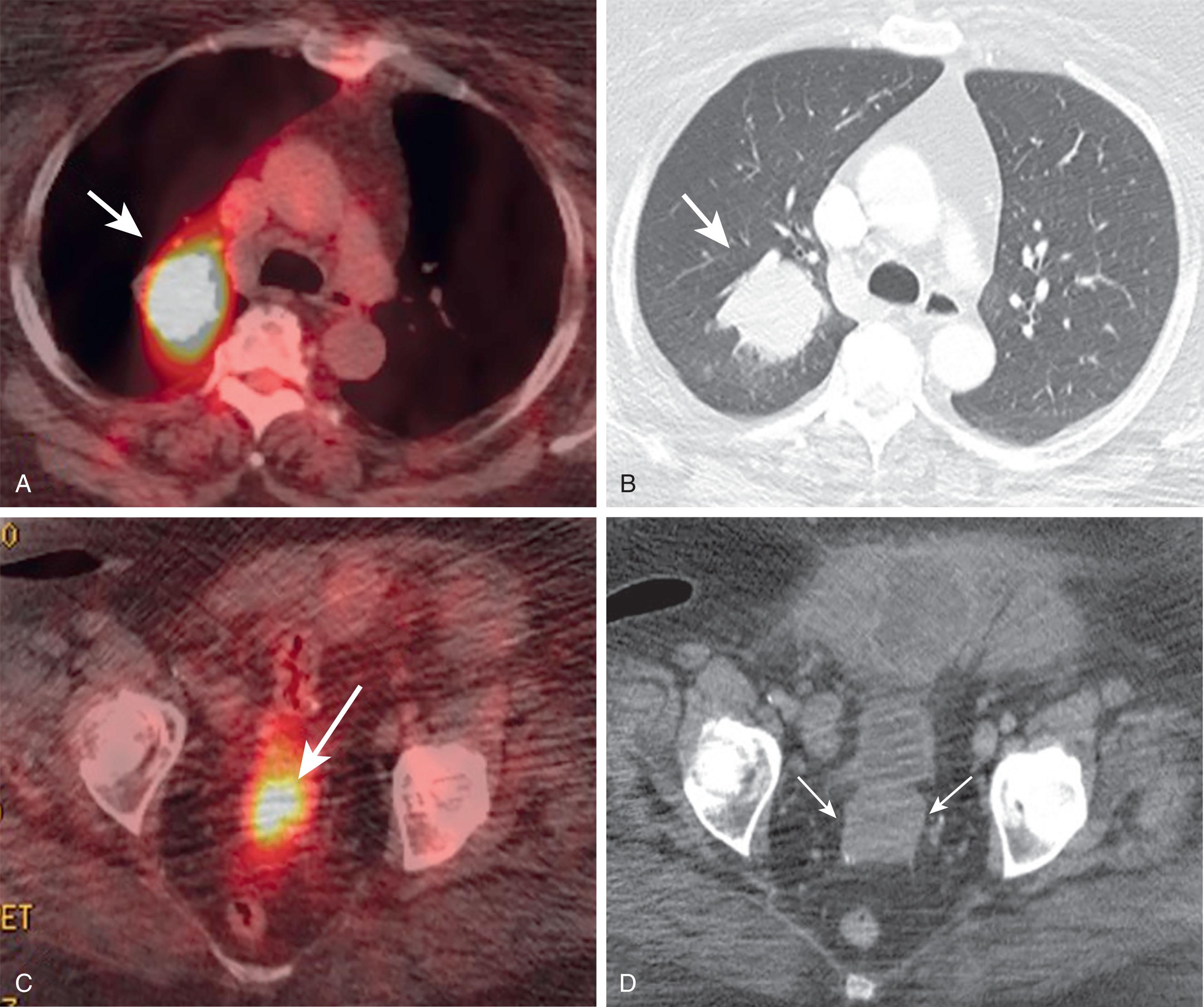Fig. 25.9, A 61-year-old woman with prior history of endometrial carcinoma, status posthysterectomy, now presenting with abnormal vaginal bleeding, suspicious for recurrence. A solid mass at the apex of the vaginal cuff was found on clinical examination. A , 2-[ 18 F] fluoro-2-deoxy-D-glucose positron emission tomography (PET)/computed tomography (CT) demonstrates a hypermetabolic right upper lobe lung mass ( white arrow ), consistent with metastatic disease. B , CT with lung windows demonstrates the right upper lobe metastasis ( white arrow ). C , PET/CT scan shows a focal area of increased metabolic activity in the vaginal cuff, consistent with recurrent disease ( white arrow ). D , Contrast-enhanced CT scan delineates the solid mass (white arrows) at the apex of the vaginal cuff.