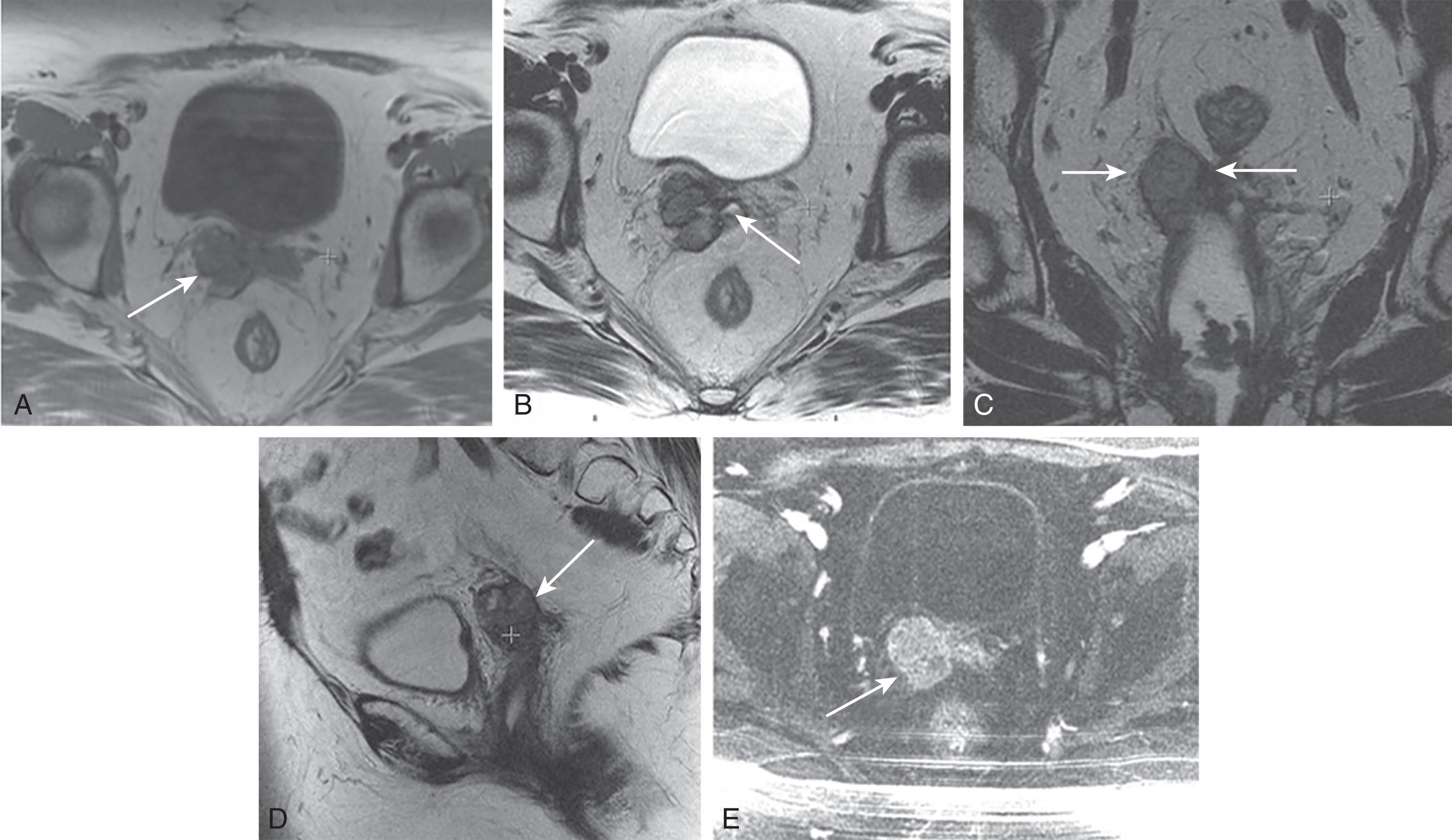 Figure 25.10, A 61-year-old woman with prior history of endometrial carcinoma, status post total abdominal hysterectomy and bilateral salpingo-oophorectomy in 2011, now presenting with vaginal bleeding. Axial T1-weighted (T1W) magnetic resonance imaging (MRI) ( A ), axial T2-weighted (T2W) MRI ( B ), coronal T2W MRI ( C ), and sagittal T2W MRI ( D ) demonstrate a lobulated mass that is heterogenous in T2 signal intensity at the level of the right lateral aspect of the vaginal cuff ( white arrows in A – D ). E , Axial T1W fat-suppressed image demonstrates avid enhancement of this mass ( white arrow ), which was histologically confirmed to be an endometrial carcinoma recurrence, for which the patient was dispositioned to pelvic exenteration.