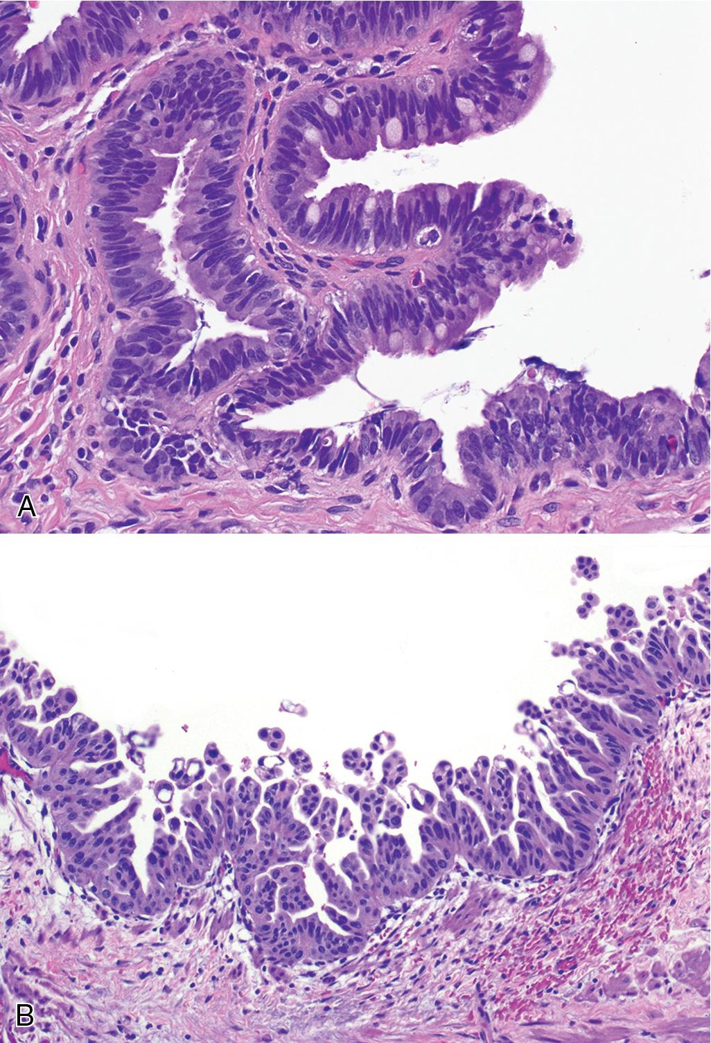 FIGURE 47.6, Dysplasia (biliary intraepithelial neoplasia).