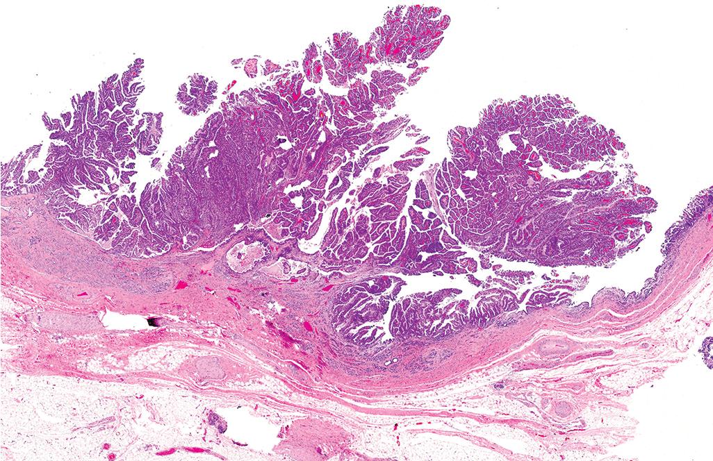 FIGURE 47.7, Intraductal papillary neoplasm.