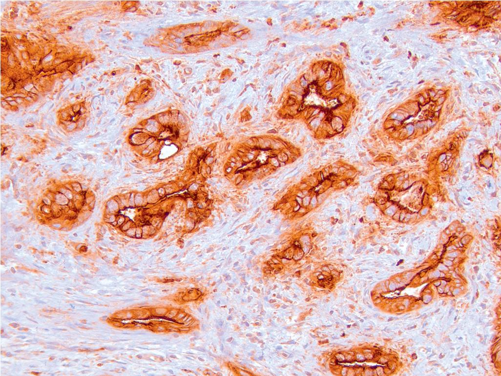 FIGURE 47.9, Mucin 1 (MUC1) in adenocarcinoma.