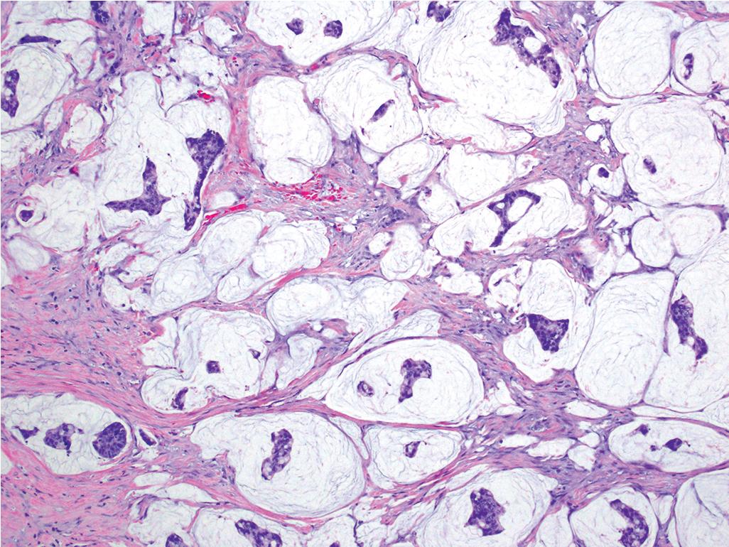 FIGURE 47.10, Mucinous carcinoma.