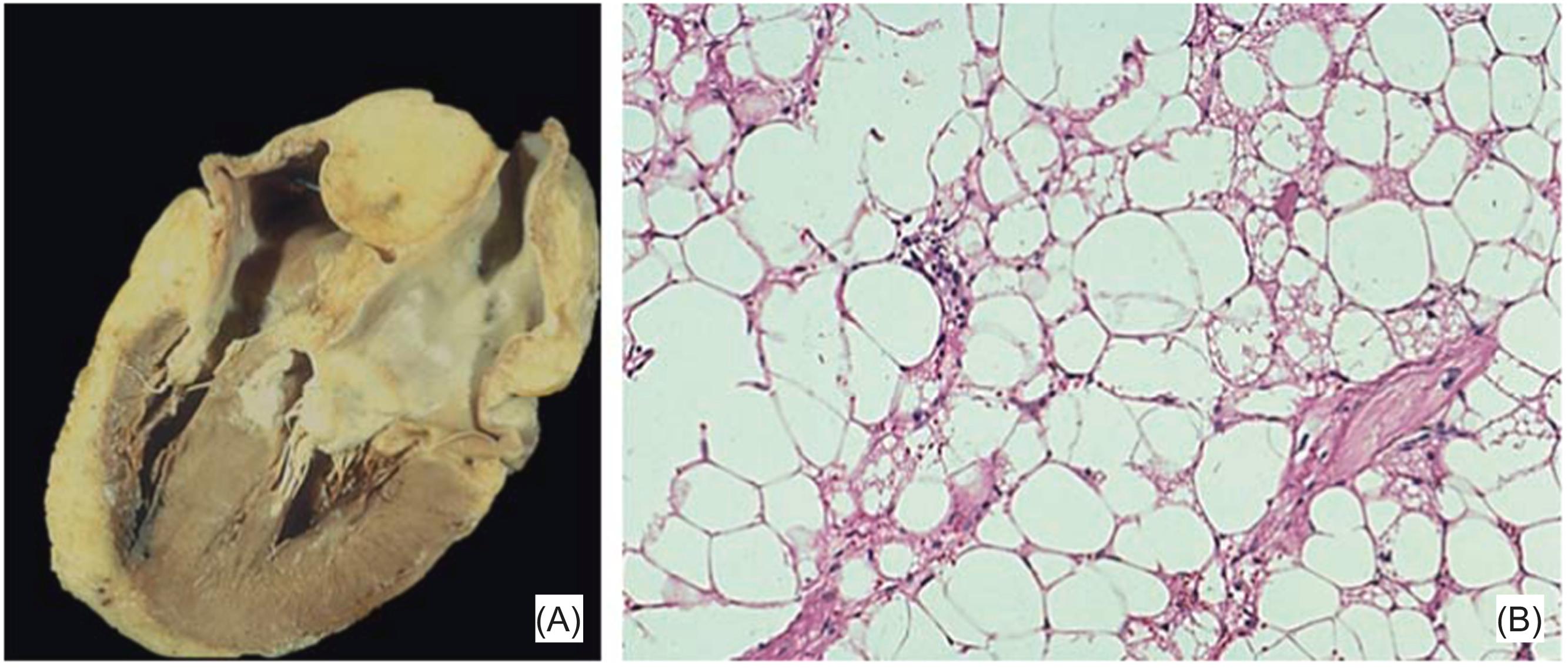 Figure 19.11, Lipomatous hypertrophy, atrial septum. (A) Gross picture of the heart with lipomatous hypertrophy of the interatrial septum, bulging into the right atrium. (B) Histologically, the lesion is composed of vesicular brown fat, enlarged cardiac myocytes, and normal fat cells.