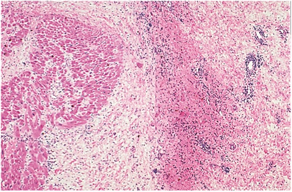 Figure 19.2, Cardiac thrombus, histologic appearance. The ventricular myocardium (left) is contrasted with the organized fibrin clot (right). Hematoxylin–eosin, 15×.