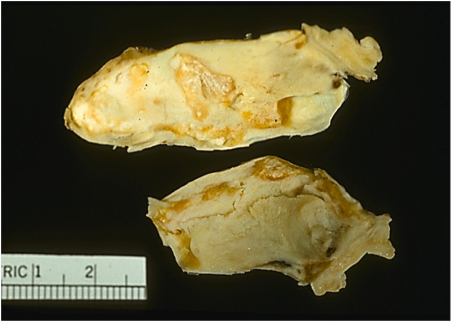 Figure 19.3, Calcified mural thrombus (pseudotumor), gross appearance. This right atrial mass was removed from a patient with antiphospholipid syndrome. There is dense calcification resulting in a rock-hard tumor that could be sectioned only after days of decalcification. The cut section is yellow tan.