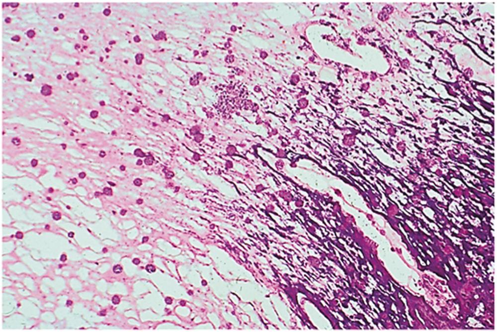 Figure 19.4, Calcified mural thrombus (pseudotumor), histologic appearance. Histologic section demonstrates areas of calcifications (purple) and amorphous hyaline stroma. Hematoxylin–eosin, 45×.