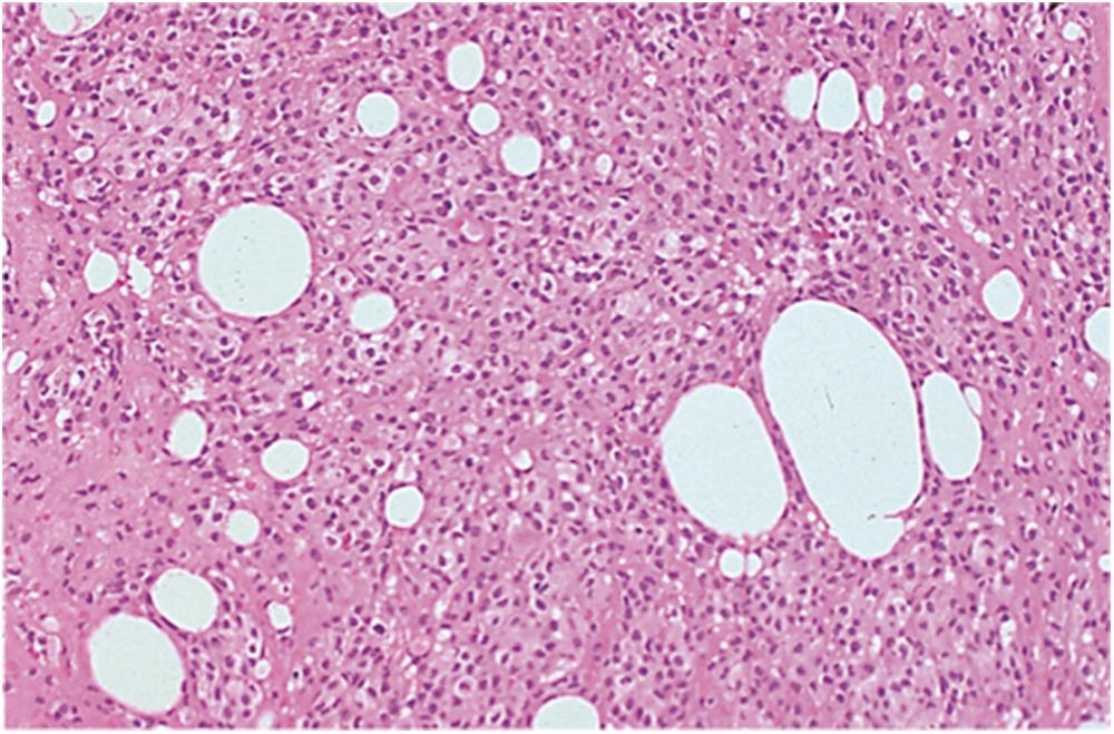 Figure 19.5, Mesothelial/monocytic incidental cardiac excrescence, histology. There is a collection of mononuclear cells and fat globules resembling a cytologic preparation. Note the absence of stroma. Hematoxylin–eosin, 45×.