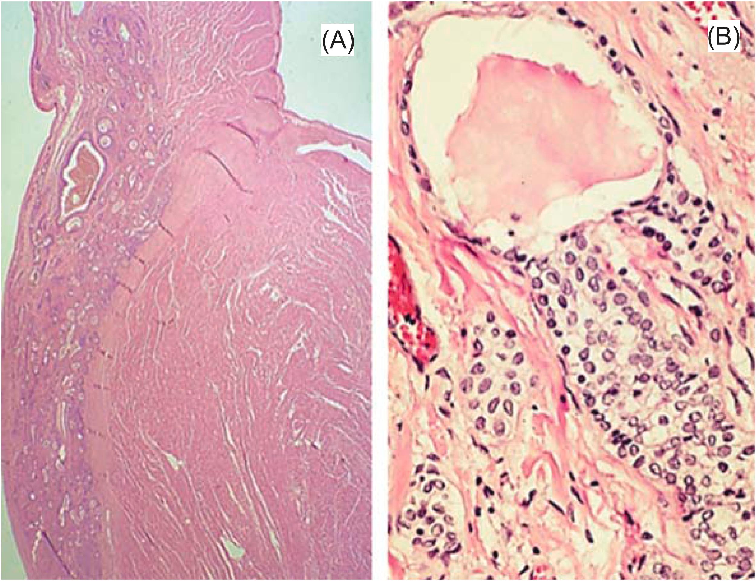 Figure 19.6, Atrioventricular nodal tumor, histology. (A) Histologic section demonstrates the cysts in the region of the atrioventricular node. They do not affect the central fibrous body. (B) The cysts are lined by epithelium composed of a mixture of transitional and cuboidal cells.
