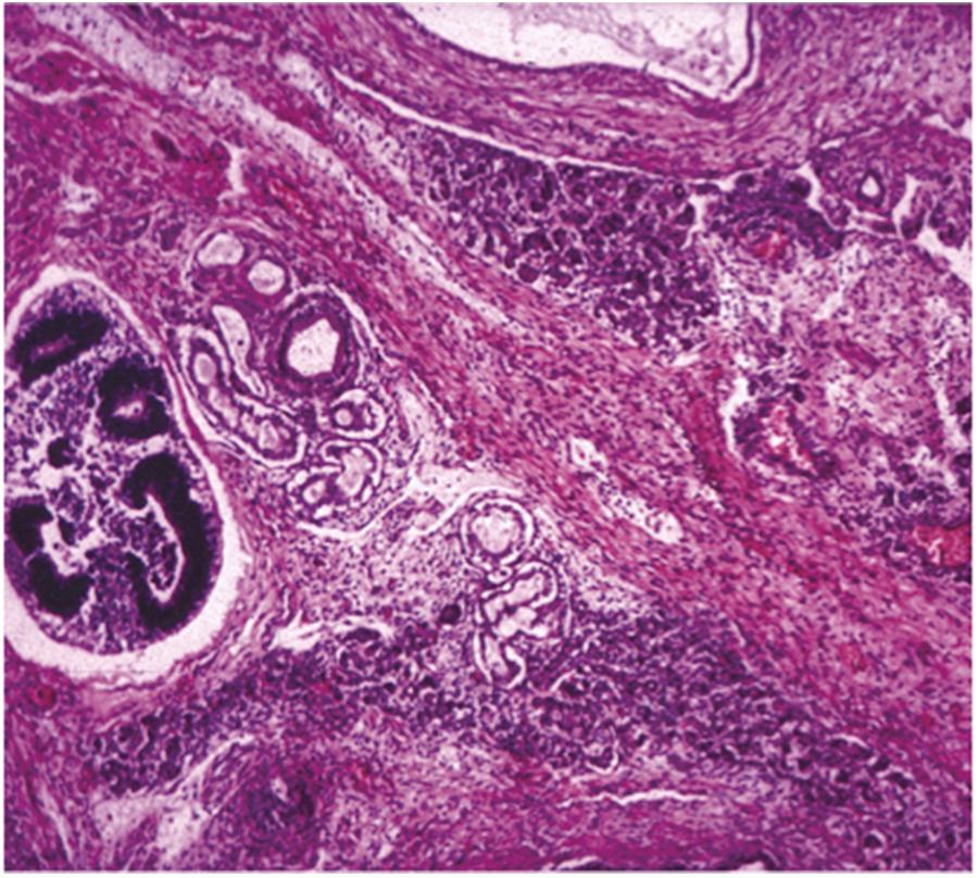 Figure 19.7, Teratoma, histology; note the presence of neural, glandular, and stromal structures.