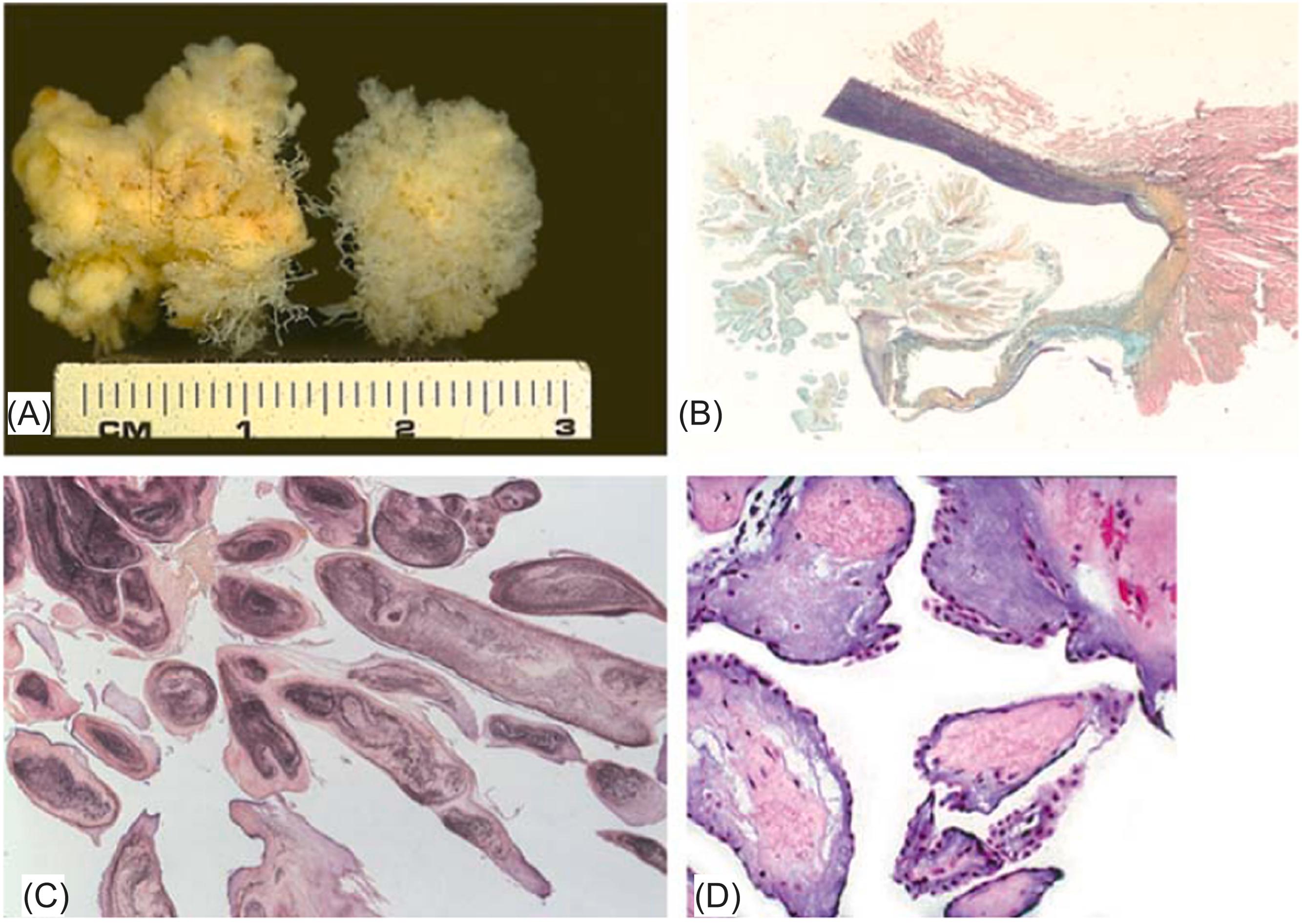 Figure 19.8, Papillary fibroelastoma. (A) Typical gross appearance when placed in water. (B) Movat stained section shows aortic valve cusp with attached central stalk and papillary fronds characteristic of papillary fibroelastoma. Higher magnification in (C) shows the avascular papillary fronds lined by endothelial cells with interspersed mesenchymal cells in the core.