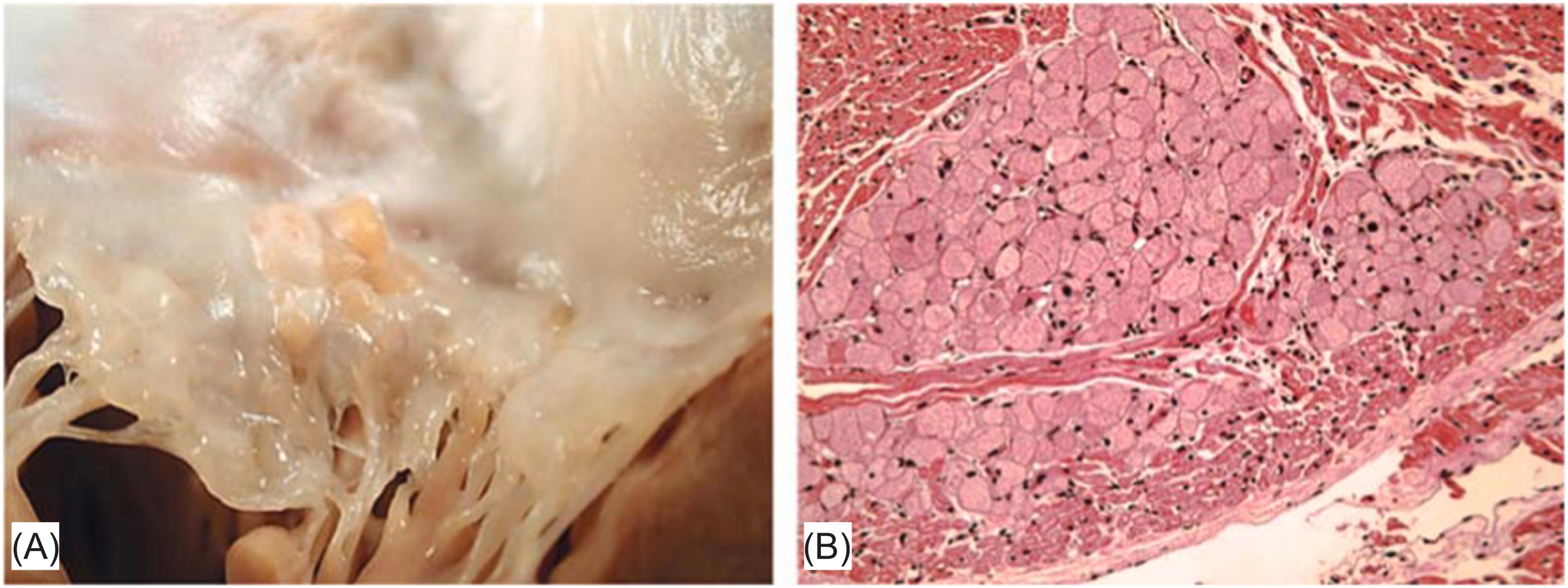Figure 19.10, Purkinje cell hamartoma (oncocytic/histiocytoid cardiomyopathy). (A) Gross picture of a heart demonstrating the left atrium and portion of the mitral valve. Note pale tan endocardial nodules at the level of the annulus. (B) There are nests of clear microvesicular cells in the center of an otherwise unremarkable myocardium (H&E stain).