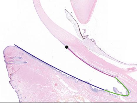 Fig. 27.1, Normal eye structure: a sagital section of an exanteration specimen illustrates the different regions of the conjunctiva – limbus in black, bulbar conjunctiva in pink, fornix in green and palpebral (tarsal) conjunctiva in dark blue.